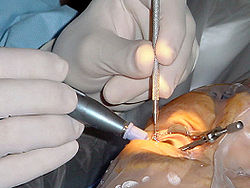 Cataracts Surgery