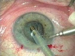 Clarivu Cataract Surgery